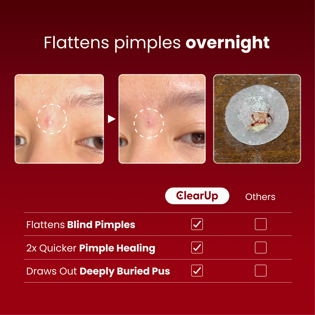 Microdarts for Acne