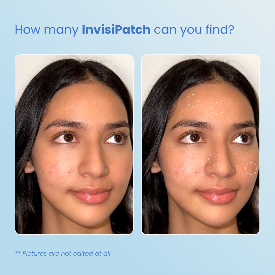 Acne First-Aid-Kit
