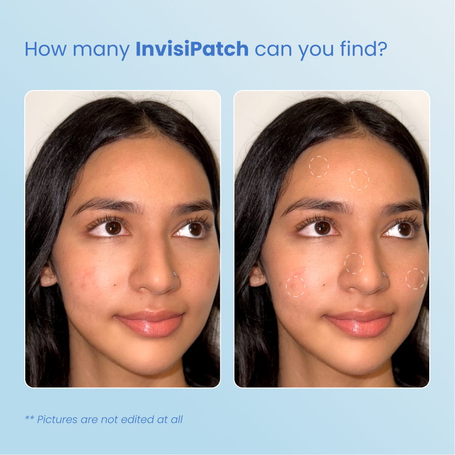 Acne First-Aid-Kit