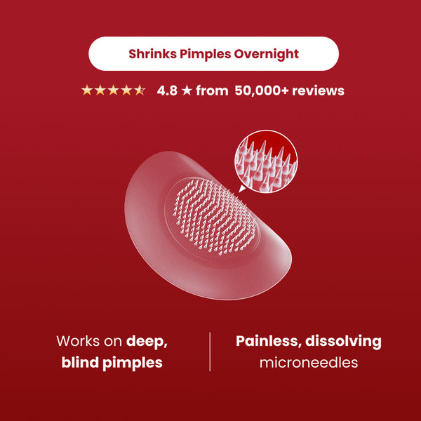 Microdarts for Acne