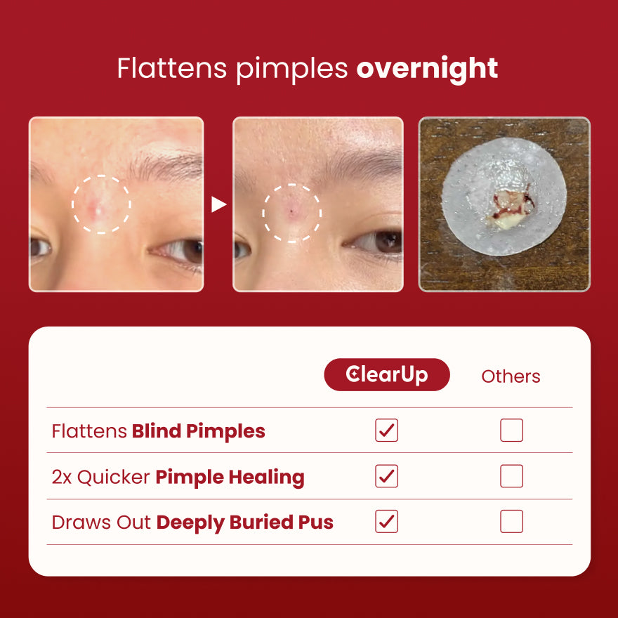 Microdarts for Acne